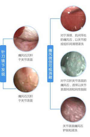针刀镜下发现痛风微创可视消融.jpg 针刀镜下发现痛风微创可视消融.jpg