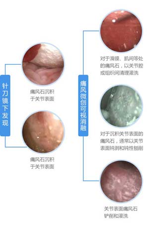 针刀镜下发现痛风微创可视消融.jpg