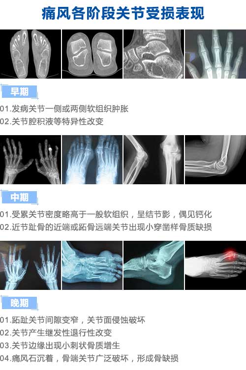 痛风各阶段关节受损表现.jpg