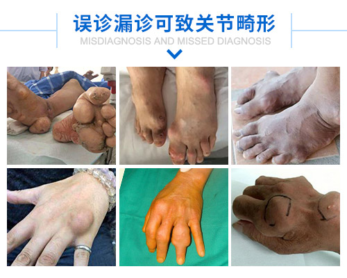 误诊漏诊可致关节畸形.jpg 误诊漏诊可致关节畸形.jpg