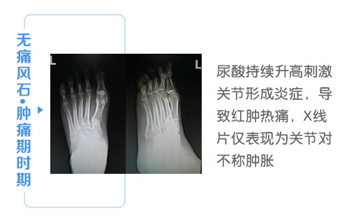 无痛风石.肿痛期时期.jpg 无痛风石.肿痛期时期.jpg