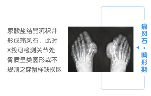 痛风石,畸形期.jpg 痛风石,畸形期.jpg