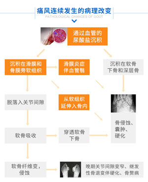 痛风连续发生的病理改变.jpg