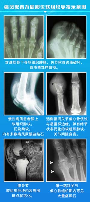 痛风患者不同部位软组织受损示意图.jpg 痛风患者不同部位软组织受损示意图.jpg