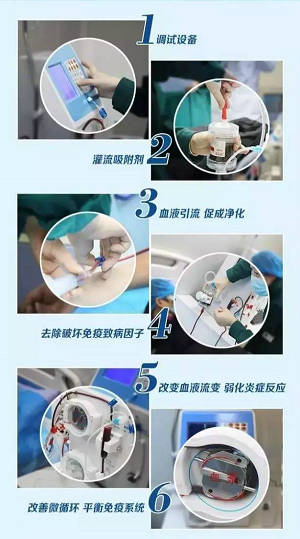 免疫吸附疗法步骤解析图.jpg 免疫吸附疗法步骤解析图.jpg