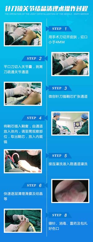 针刀镜关节结晶清理术操作过程.jpg 针刀镜关节结晶清理术操作过程.jpg