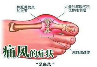 痛风石切除痛风还发作？郑州痛风风湿病医院痛风专家杜爱华替你解答