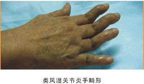 郑州痛风风湿病医院杜爱华专家讲解类风湿的健康指导！