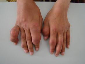 手部是痛风的主要部位之一，那么，手部痛风有什么症状呢？