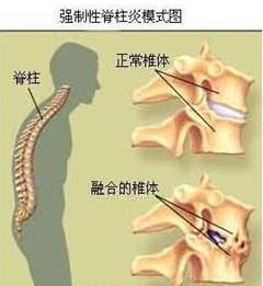 强直性脊柱炎的晚期症的特色