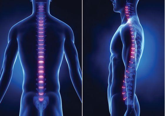 医生概述:强直性脊柱炎的发展进程分为6步