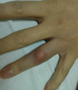 什么是痛风石？从痛风